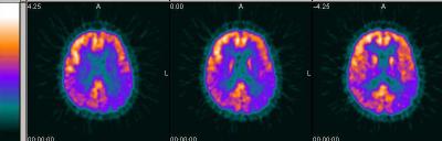 alzheimer
